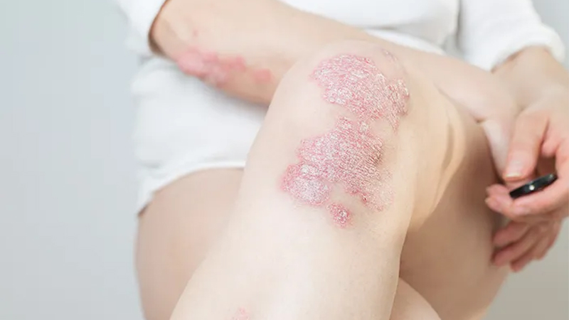 PAFI Kota Pulang Pisau – Cara Mencegah Penyakit Psoriasis, Perawatan Kulit yang Tepat